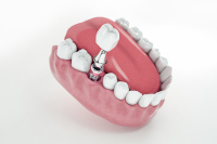 conseils-patients-pour-reduire-echecs-implantaires-dentiste-massy