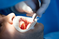 innovation-implants-dentaire-substitut-osseux-greffes-dentiste-massy